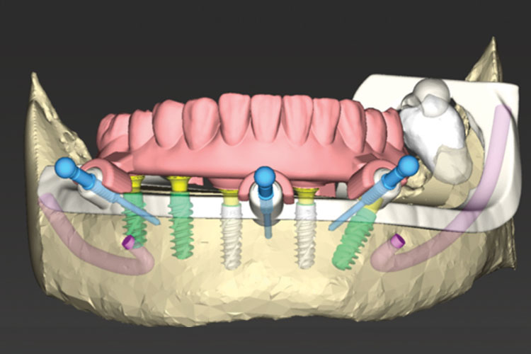 Digital Implant Planning