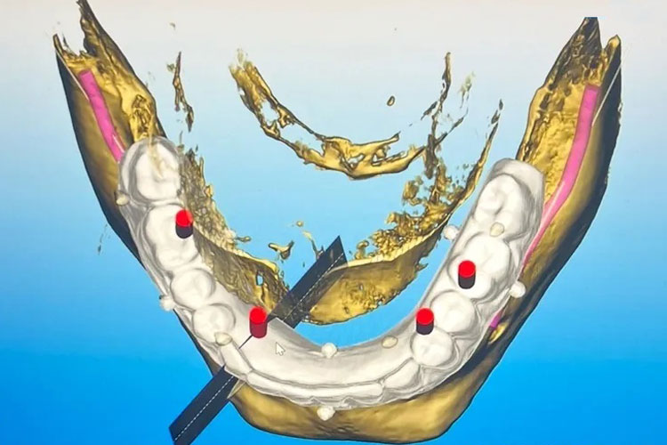 Digital Implant Planning - Picture 1