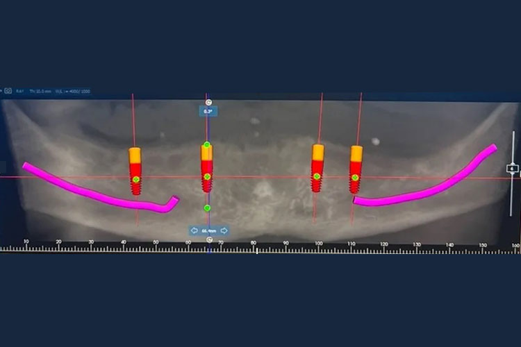 Digital Implant Planning - Picture 2