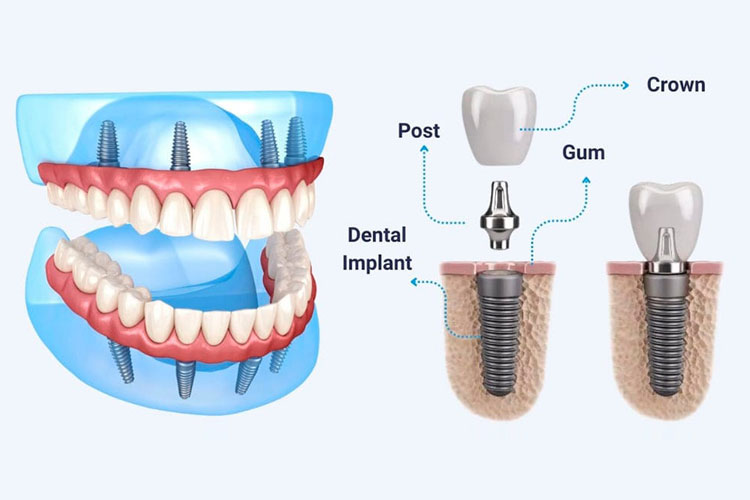 All On 4 Dental Implants