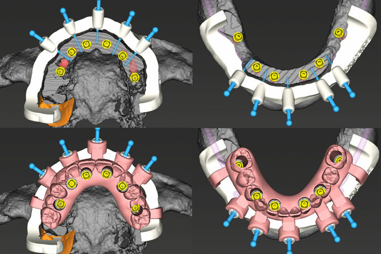 Digital Implant Planning