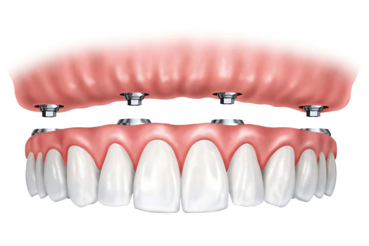 Full Arch Implant Solution