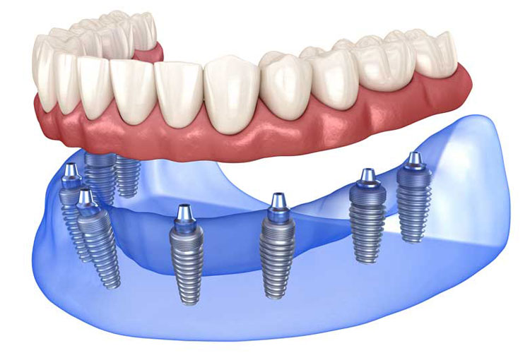 Full Arch Implants