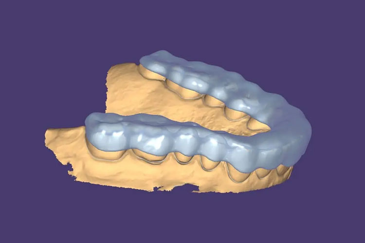 Dental Night Guard Design & Fabrication